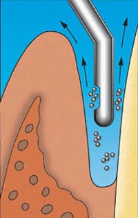 Max-i-Probe Endodontic/Periodontal Irrigation Probes, #70, 23 Ga x 1", Light Blue, 100/Box, MAXP231 thumbnail 2