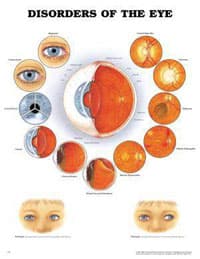 Disorder of the Eye Educational Chart, 20" x 26", Each - Chart Disorder of the Eye - Image 1