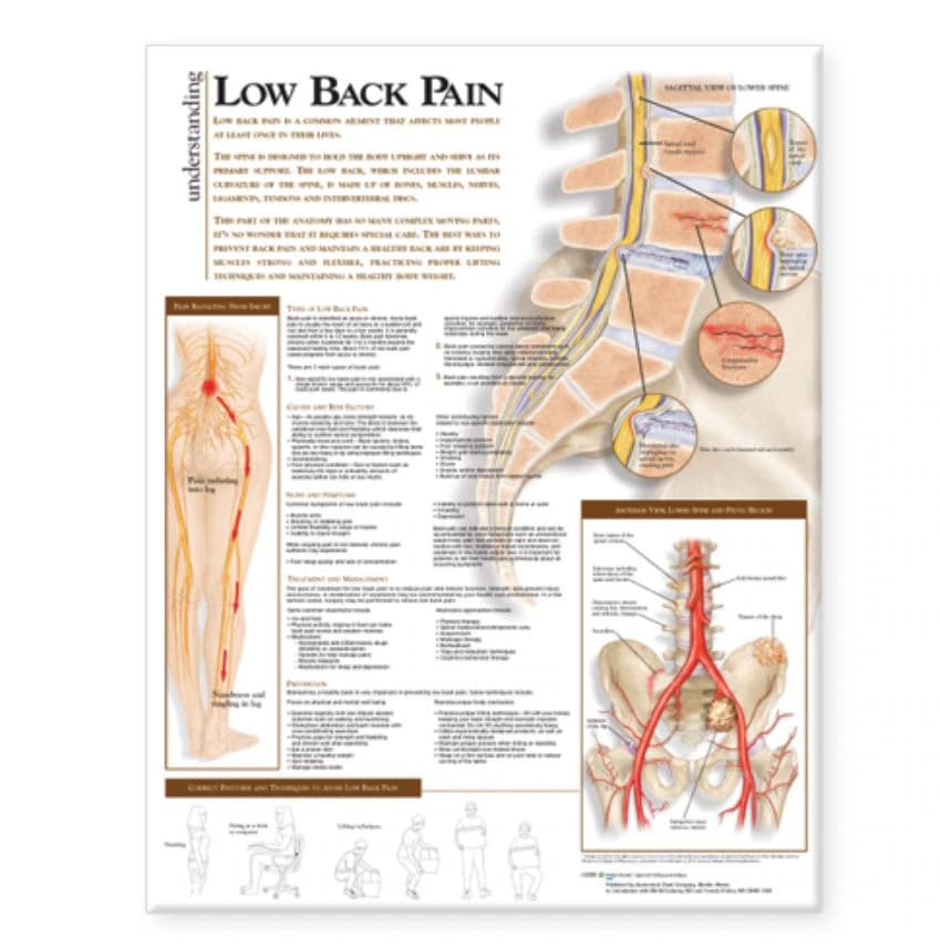Understanding Lower Back Pain Anatomical Chart, 20" x 26", Flexible, Each - Chart Understanding Low Back - Image 1