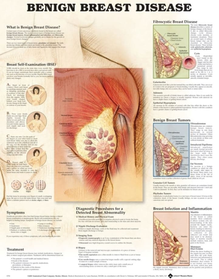 Benign Breast Disease Anatomical Chart, 20" x 26", Each - Chart Anat Benign Brst Disease - Image 1