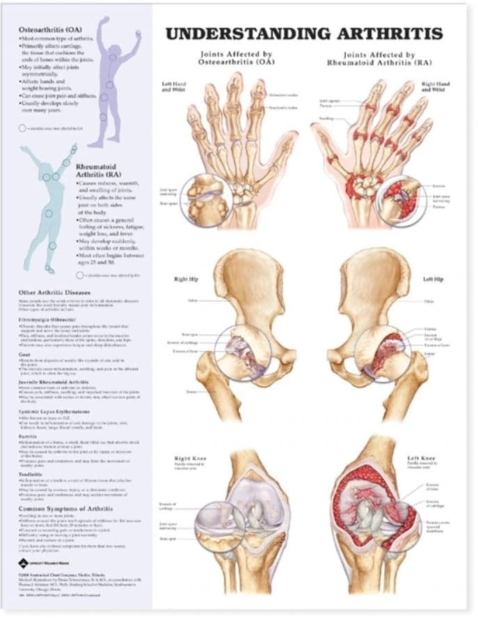 Understanding Arthritis Educational Chart, 20" x 26", Each - Chart Understanding Arthritis - Image 1