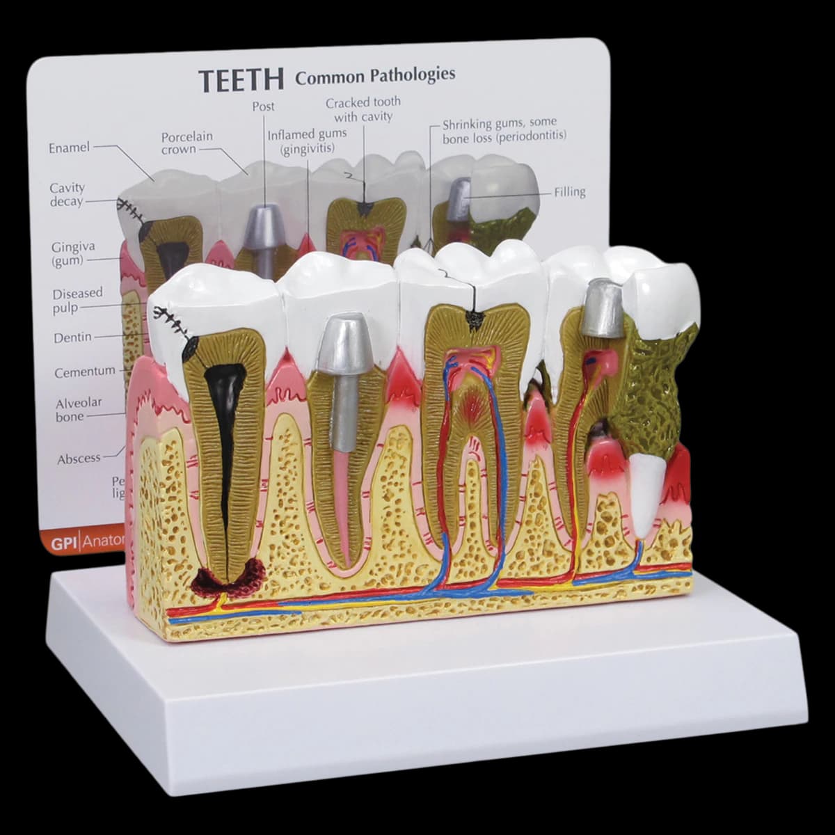 GPI Anatomicals Model Diseased Teeth & Gum Patient Education Model, 6 in x 6 in x 5.5 in - Model Diseased Teeth & Gum - Image 1