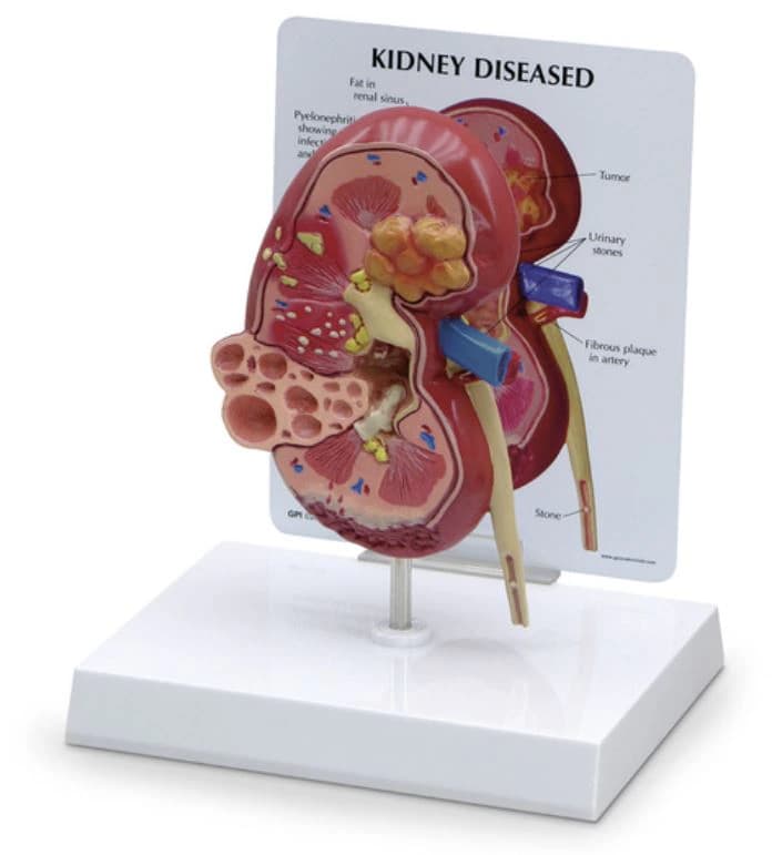 Nasco Healthcare Kidney Anatomical Model with Pathologies, 3-3/4 x 2-1/2 x 6-1/2 in, Each - Model Kidney - Image 1