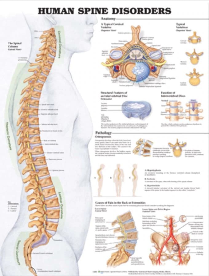 Anatomical Chart Spine Disorders, 20" x 26", Each - Chart Anat Spine Disorder - Image 1