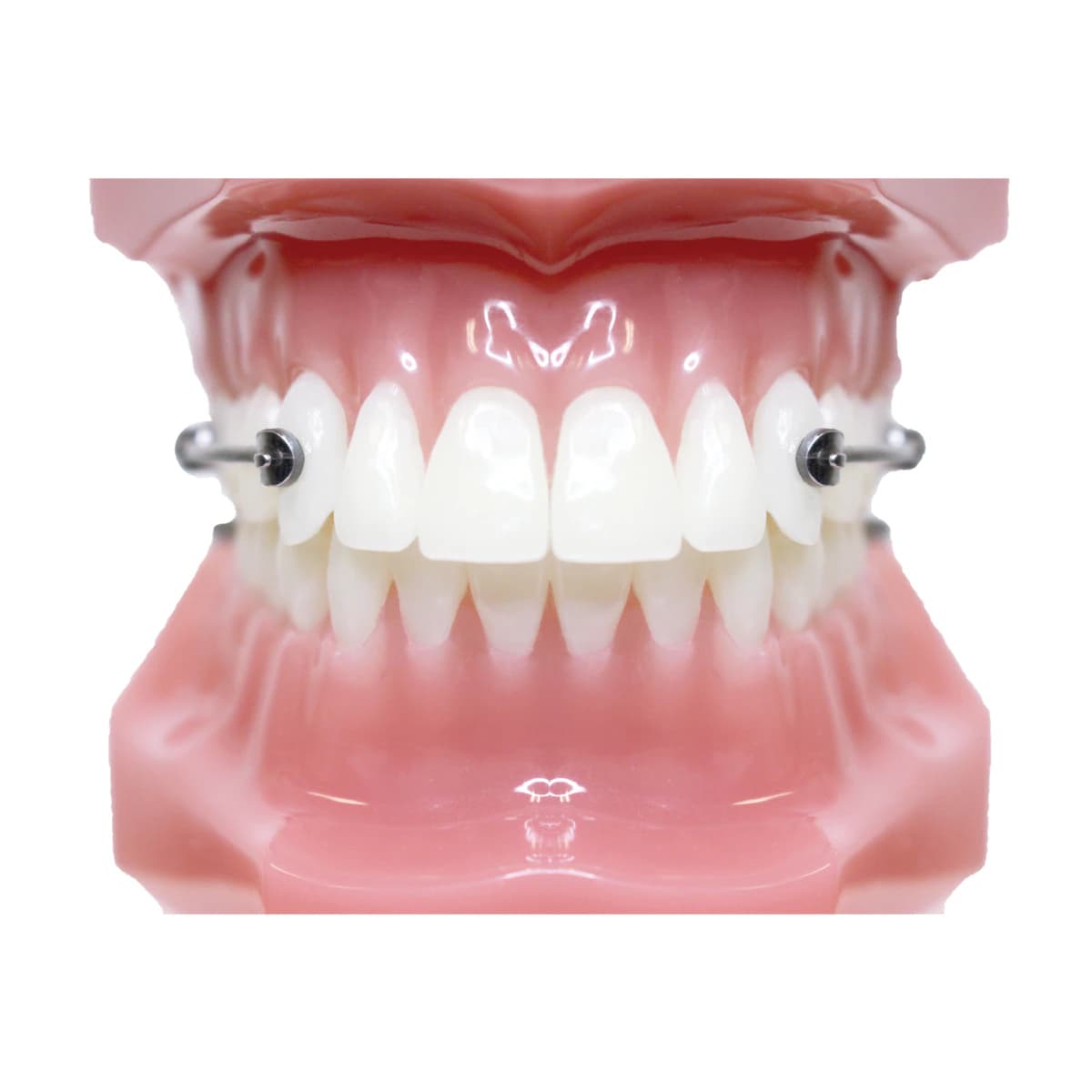 Carriere Motion 3D Class II Typodont, Each - Typodont MotionsEssix Anchorag - Image 1