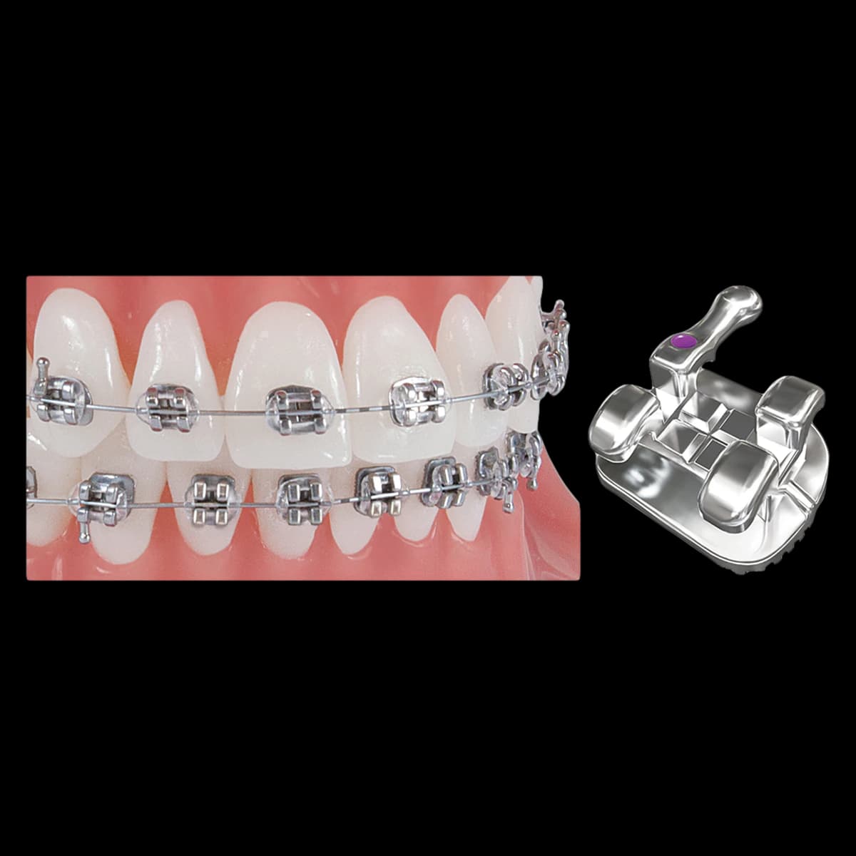 Pinnacle Roth Individual Brackets, 0.022 in, Upper Right Central (UR1), Maxillary Arch, 10/Box - Pinnacle Roth Individual Brackets - Image 1