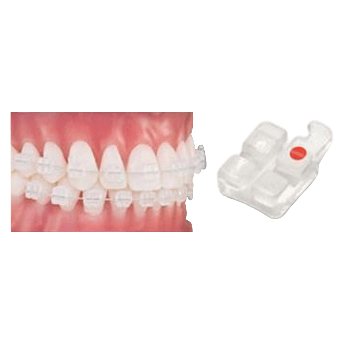 PURE Sapphire Roth Individual Brackets, 0.022 in, Upper Right Central (UR1), 10/Box, Ortho Technology - PURE Sapphire Roth Individual Brackets - Image 1