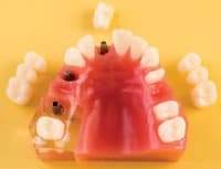 Model Implant Crown & Bridge Patient Education Model with Foam-Lined Storage Case - Model Implant Crown & Bridge - Image 1