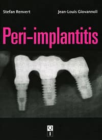 Peri-Implantitis: A Comprehensive Guide to Etiology, Diagnosis, and Treatment (Quintessence Publishing, ISBN 978-2-912550-98-9) - Peri-Implantitis / Renvert Stefan; Giovannoli Jean-Louis - Image 1
