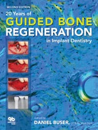 20 Years of Guided Bone Regeneration in Implant Dentistry, 2nd Edition (Buser Daniel), 272 pp, ISBN 978-0-86715-401-6 - 20 Years of Guided Bone Regeneration in Implant Dentistry Second Edition / Buser Daniel - Image 1
