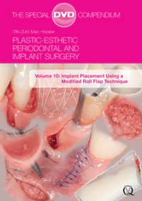 DVD Plastic-Esthetic Periodontal and Implant Surgery: Implant Placement Using a Modified Roll Flap Technique, Volume 10 - DVD Plastic-Esthetic Perio Imp - Image 1