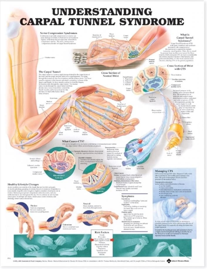 Understanding Carpal Tunnel Syndrome Educational Chart, 20" x 26", Flexible, Each - Chart Carpal Tunnel Syndrome - Image 1