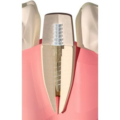 Flexi-Flange Stainless Steel Post Introductory Kit, Sizes 0, 1, 2, 410-00 thumbnail 8