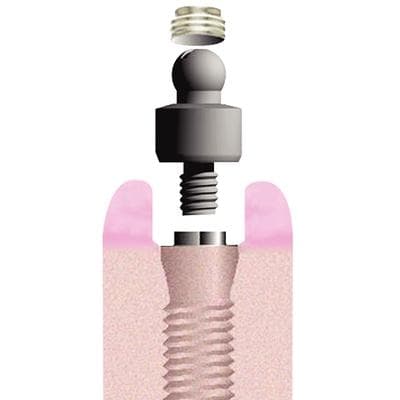 Flexi-Overdenture EZ-Change Keeper & Cap Inserts Intro Kit thumbnail 7