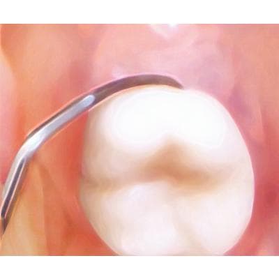 PDT Amazing Gracey 11/12 Curette, Double-Ended, Sunshine Yellow Resin Handle, 6.5", R026 thumbnail 15