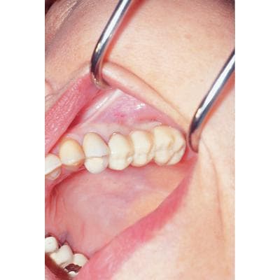 DirectCrown Adult Posterior Bridge Kit, Opaque, 16 Bridges Sizes 1-8, with Powder, Liquid & Accessories thumbnail 5