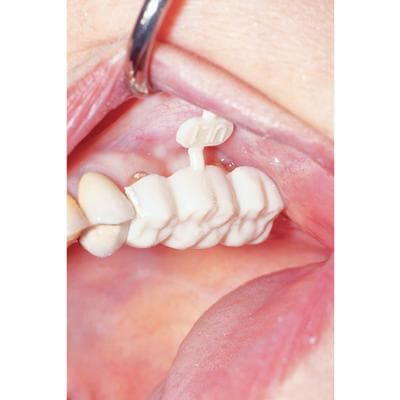 DirectCrown Adult Posterior Bridge Kit, Opaque, 16 Bridges Sizes 1-8, with Powder, Liquid & Accessories thumbnail 6