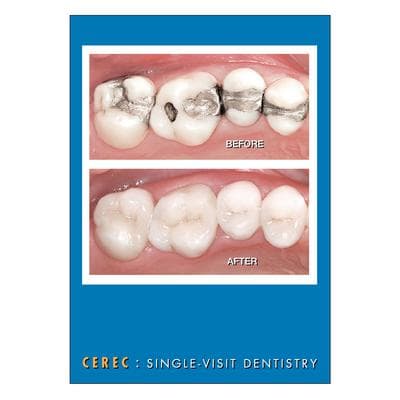 CEREC Postcards, Before & After, 4-1/4" W x 5-1/2" H, Full Color, 100/Pkg - CEREC Postcards, 100/Pkg - Before & After, 4-1/4" W x 5-1/2" H - Image 1