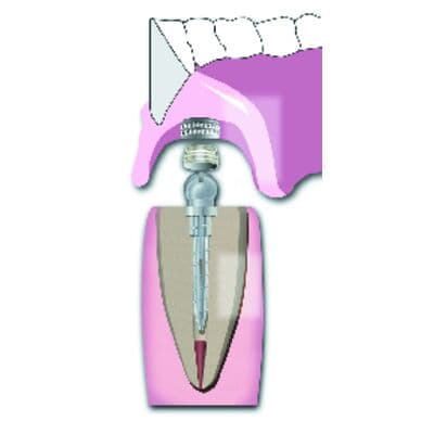 Flexi-Overdenture Attachment Caps, Nylon Female Caps with Rubber Bands, 6/Pkg, 290-01 thumbnail 7