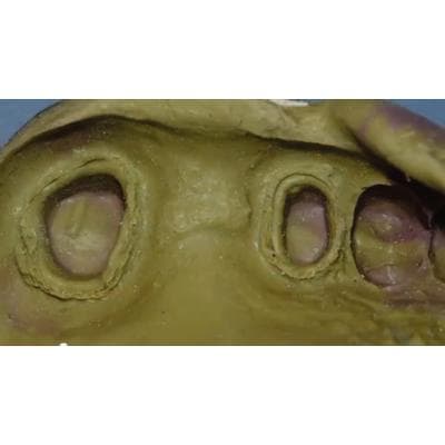 Dr. Christensen's Predictable Fixed and Removable Prosthodontic Impressions DVD - Dr. Christensen's Predictable Fixed and Removable Prosthodontic Impressions DVD - Dr. Christensen's Predictable Fixed and Removable Prosthodontic Impressions DVD - Image 1