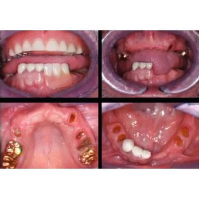 Dr. Christensen's Restoring Mini Implants DVD - Dr. Christensen's Restoring Mini Implants DVD - Dr. Christensen's Restoring Mini Implants DVD - Image 1