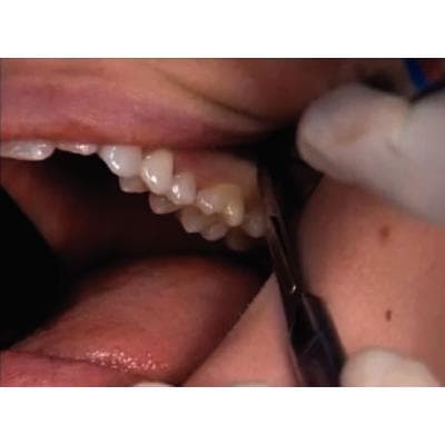 Dr. Christensen's Easy Third Molar Extraction DVD - Dr. Christensen's Easy Third Molar Extraction DVD - Dr. Christensen's Easy Third Molar Extraction DVD - Image 1