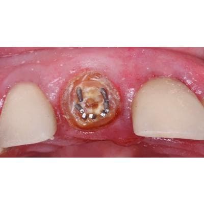 Dr. Christensen's How to Repair and Maintain Fixed Restorations DVD - Dr. Christensen's How to Repair and Maintain Fixed Restorations DVD - Dr. Christensen's How to Repair and Maintain Fixed Restorations DVD - Image 1