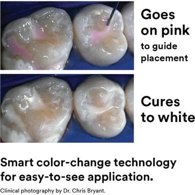 3M Clinpro Sealant Refill Bottle, 6 mL, Pink-to-White Color-Change, Fluoride-Releasing, 1/Pk, 12622 thumbnail 15