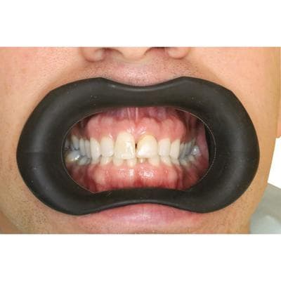 Spandex Advanced Lip & Cheek Retractor, Standard, Black, Medical Grade Silicone, 605458 thumbnail 5