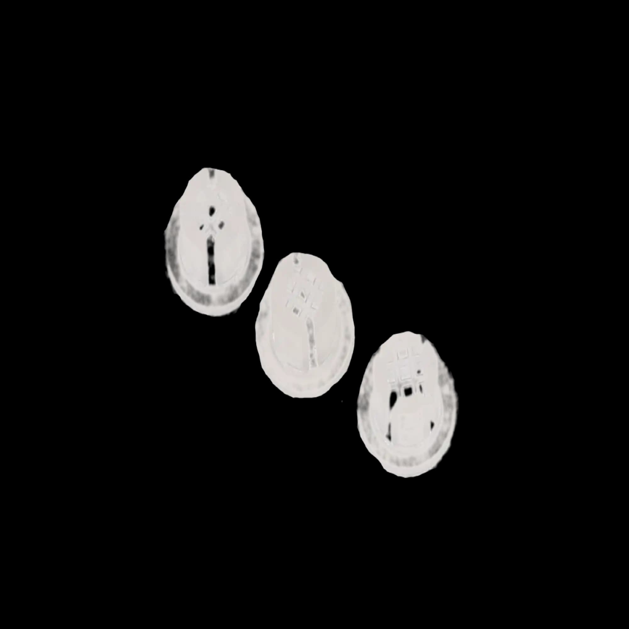 Disposable Saliva Ejector Trap Screens, Plastic, Universal, 72/Pk, 101236 thumbnail 3