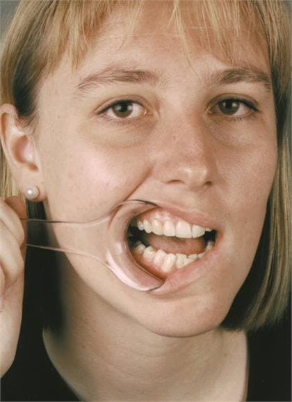 Mirahold Cheek Retractor, Adult, Single-Sided, Clear Plastic, 2/Pk, 605450 thumbnail 12
