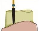 Coltene Alpen Multi-Use Multilayer Diamond Bur, FG, Medium Grit, Beveled Cylinder/Torpedo, #878-016, 1.6 mm Head Diameter, 8 mm Head Length, 5/Pkg thumbnail 4