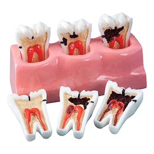 Caries Progression Model, 5 1/2" Long, 4112158 thumbnail 2
