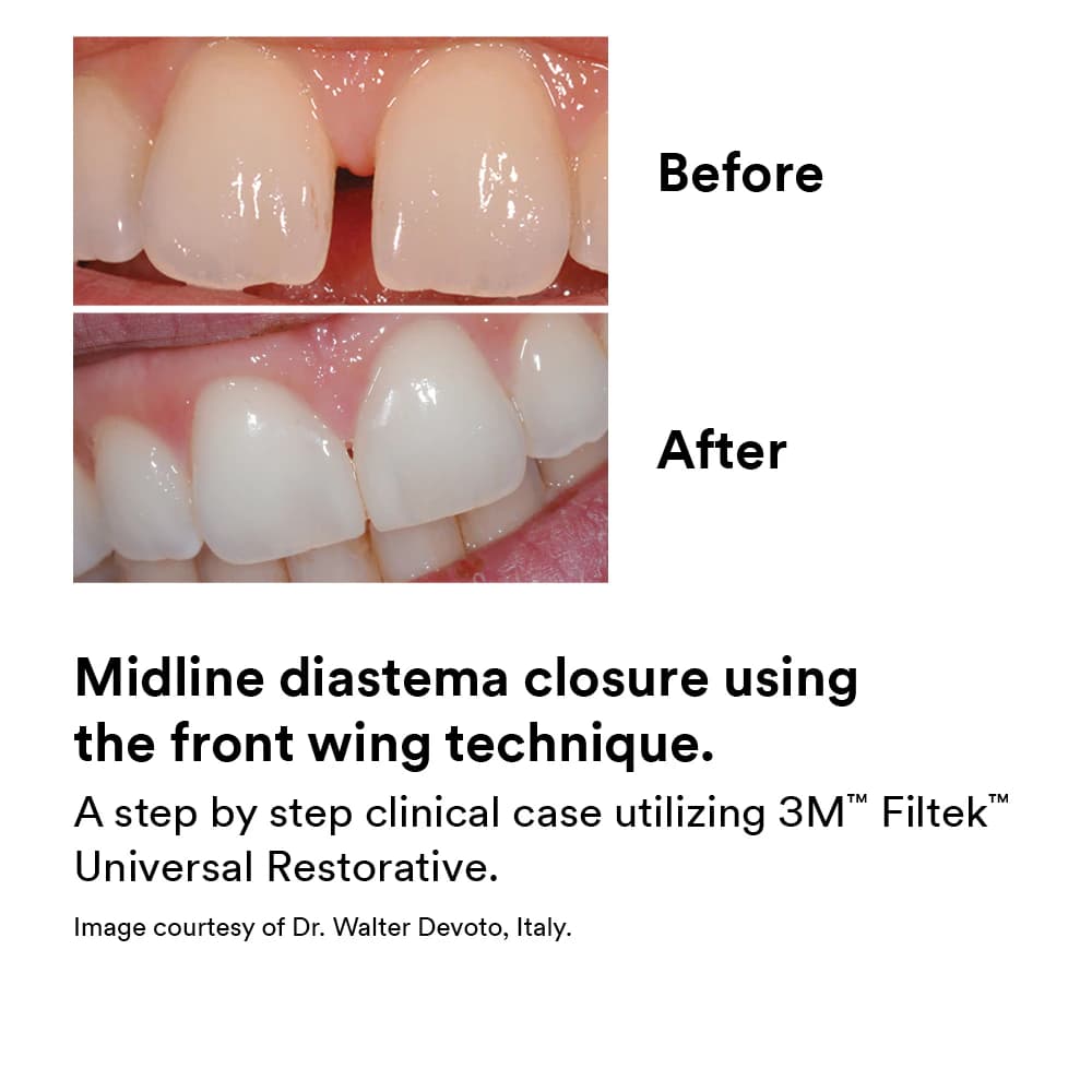 3M Filtek Universal Restorative Capsules, Shade B2, 0.2 g, 20/Box, 6550B2 thumbnail 7