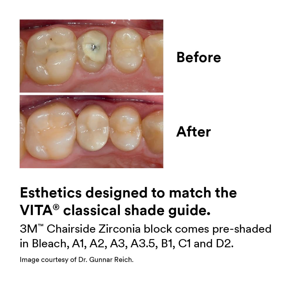 3M (Solventum) Chairside Zirconia Intro Kit for CEREC, 5 Blocks (4 Crown Blocks: 1xA1, 2xA2, 1xA3; 1 Bridge Block: A2), 20mm & 39mm, 69956 thumbnail 6