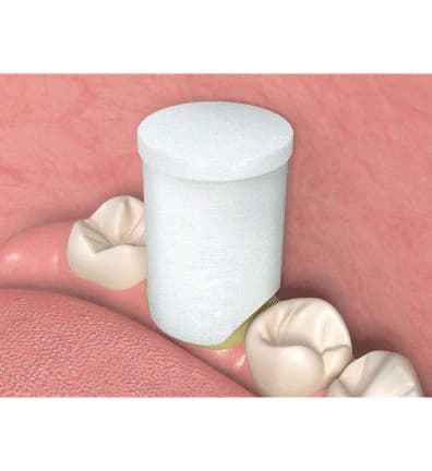 Premier Traxodent Retraction Caps, Size #1 Small, 120/Pk, 9048251 thumbnail 7