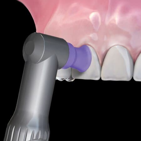 Hu-Friedy Disposable Prophy Angle, Soft Cup, Purple, Straight, Latex-Free, 100/Box, DPA-SS thumbnail 5