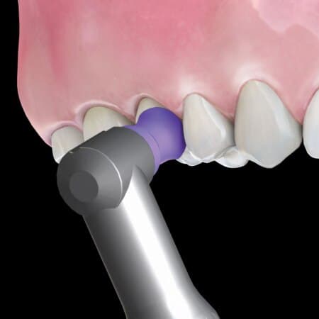 Hu-Friedy Disposable Prophy Angle, Soft Cup, Purple, Straight, Latex-Free, 100/Box, DPA-SS thumbnail 10