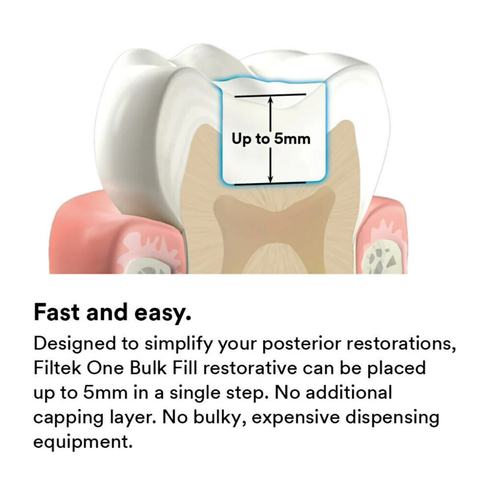 3M Filtek One Bulk Fill Restorative Syringe Refill, 4g, Shade A1, 4866A1 thumbnail 10
