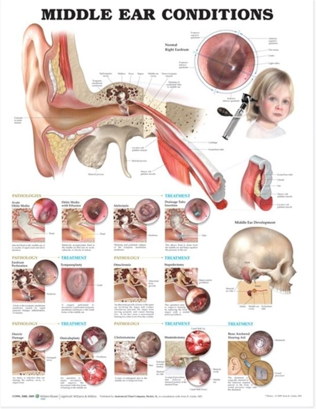 Middle Ear Conditions Anatomical Chart, 20" x 26", Flexible (Laminate), Each