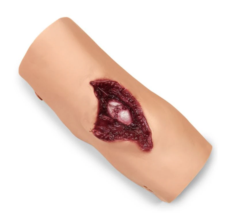 Nasco Healthcare Compound Fracture Humerus Training Moulage