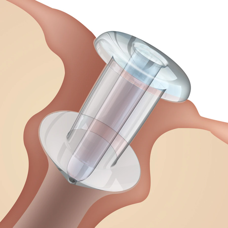 Oasis Medical Soft Plug Punctal Flow Control Plug, 0.6mm