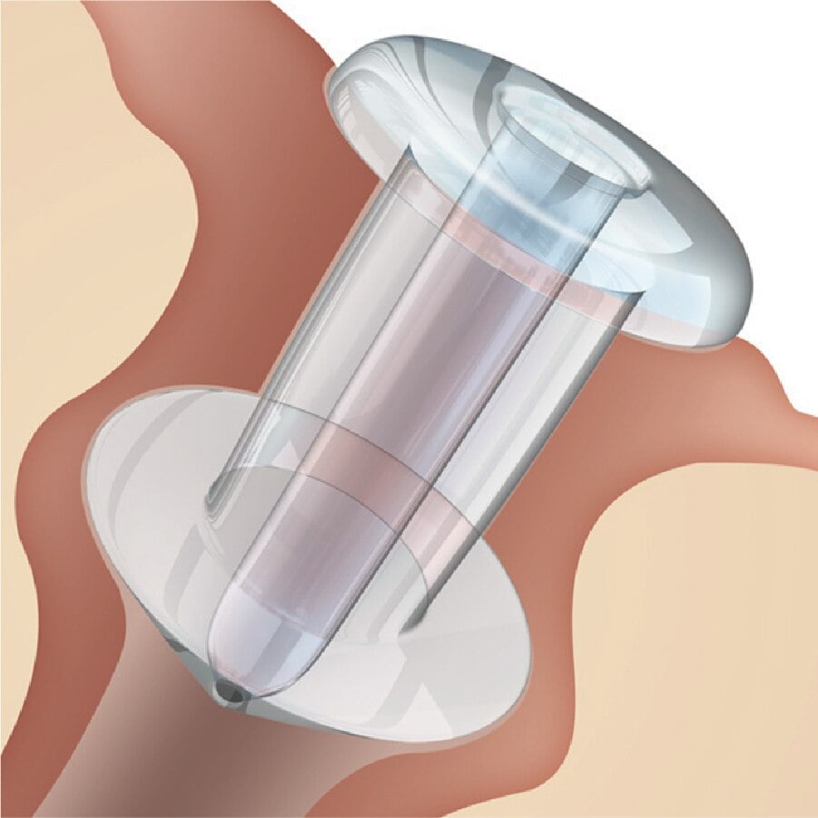 Oasis Medical Soft Plug Punctal Flow Control Plug, 0.7mm