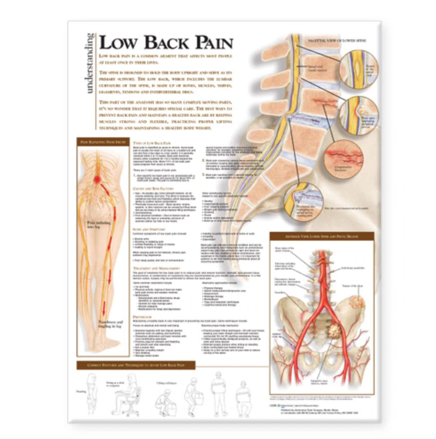 Understanding Lower Back Pain Anatomical Chart, 20" x 26", Flexible, Each