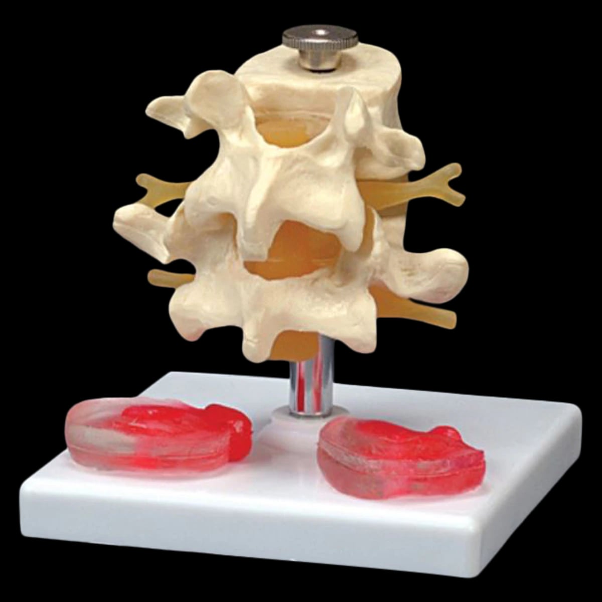 Lumbar Vertebrae Anatomical Model Set with 3 Interchangeable Discs, Mounted, 4-1/4 x 4-1/4 x 5-1/4 in