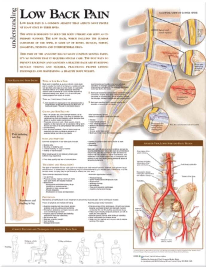 Understanding Low Back Pain Anatomical Chart, 20" x 26", Each
