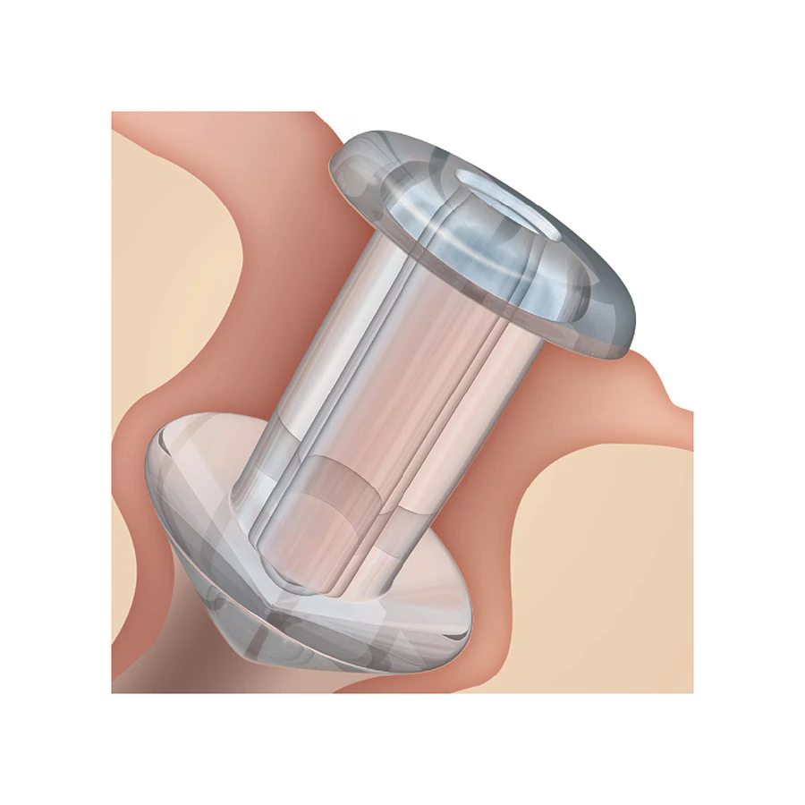 Oasis Medical Soft Plug Silicone Punctum Plug, 0.5mm, Mini
