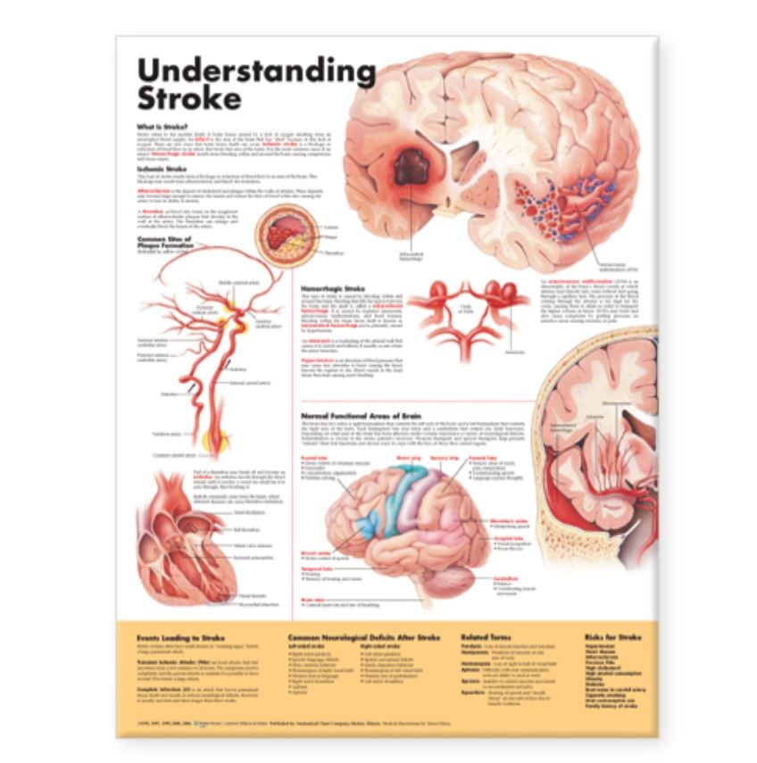 Stroke Anatomical Chart, 20" x 26", Each