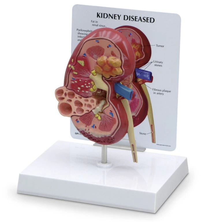 Nasco Healthcare Kidney Anatomical Model with Pathologies, 3-3/4 x 2-1/2 x 6-1/2 in, Each