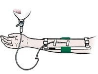 Ace Surgical Child Elbow Immobilizer, 7 inch